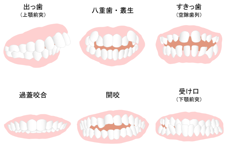 悪い歯並びの例