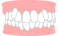 ガチャ歯（叢生）