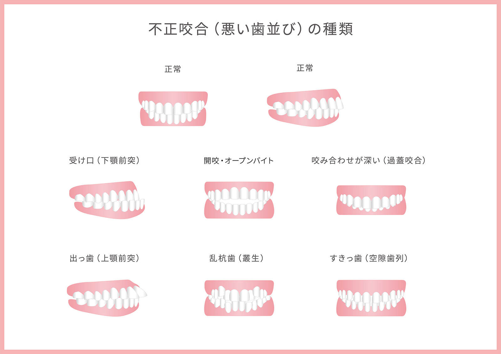 顔つきの変化が起こりやすい歯並び